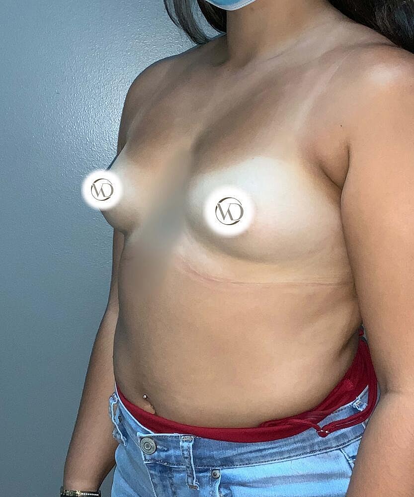 Breast Augmentation Before & After