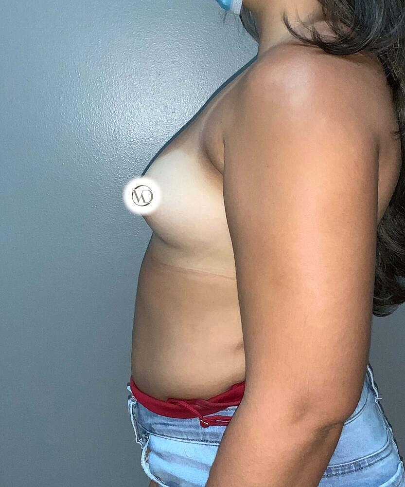 Breast Augmentation Before & After