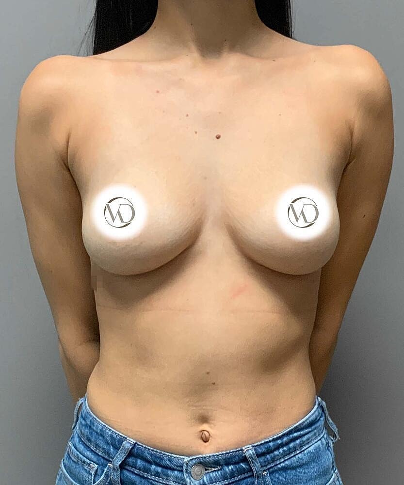 Breast Augmentation Before & After