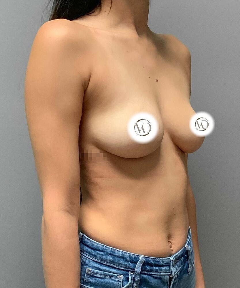 Breast Augmentation Before & After