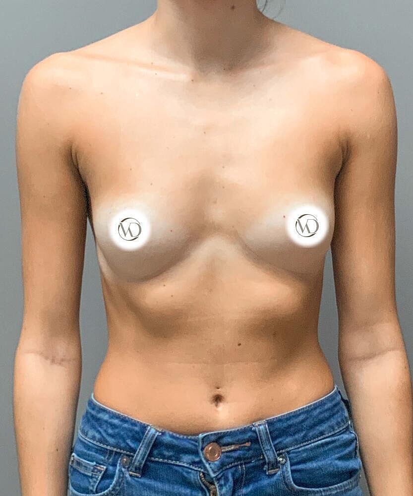 Breast Augmentation Before & After