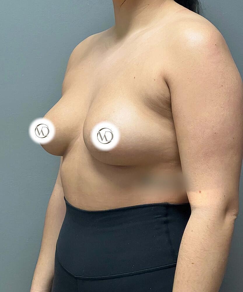 Breast Augmentation Before & After