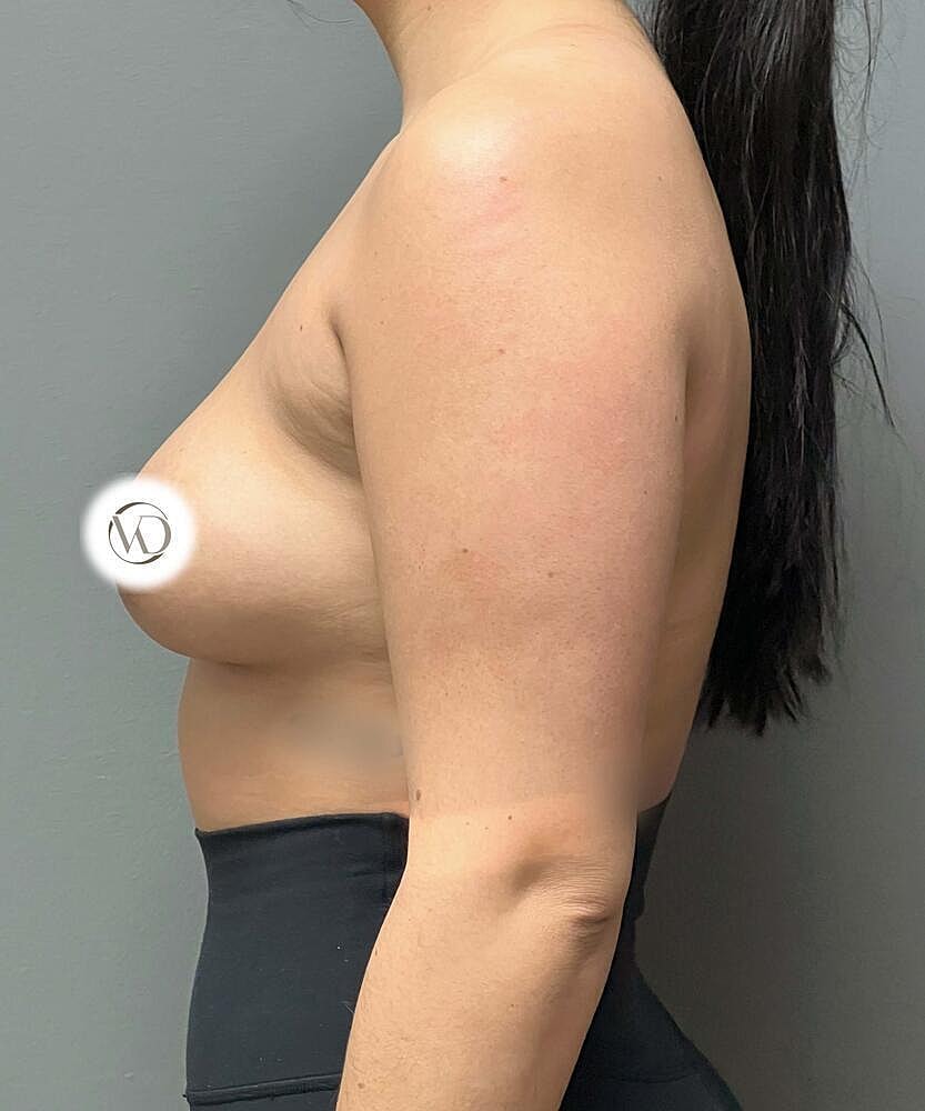 Breast Augmentation Before & After