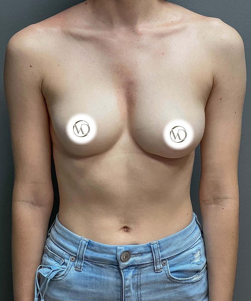 Breast Augmentation Before & After