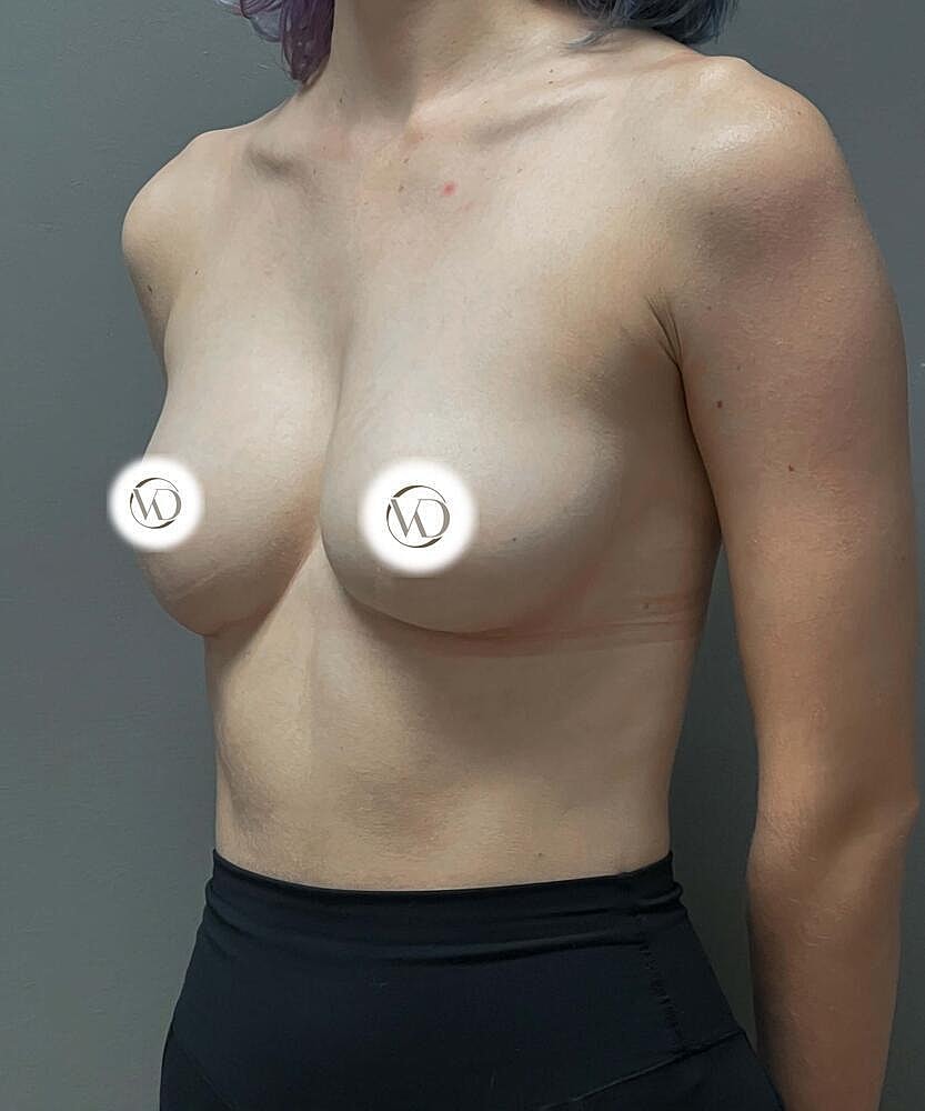 Breast Augmentation Before & After