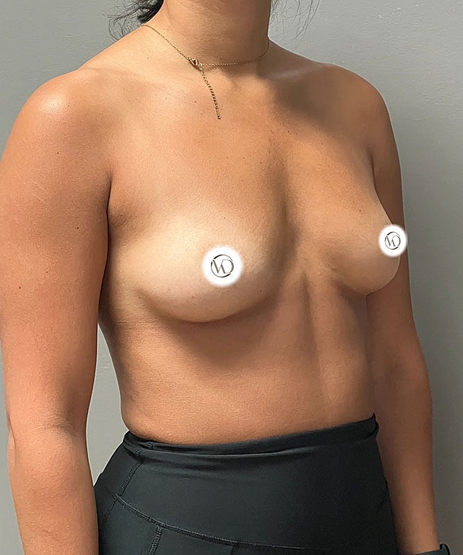 Breast Augmentation Before & After