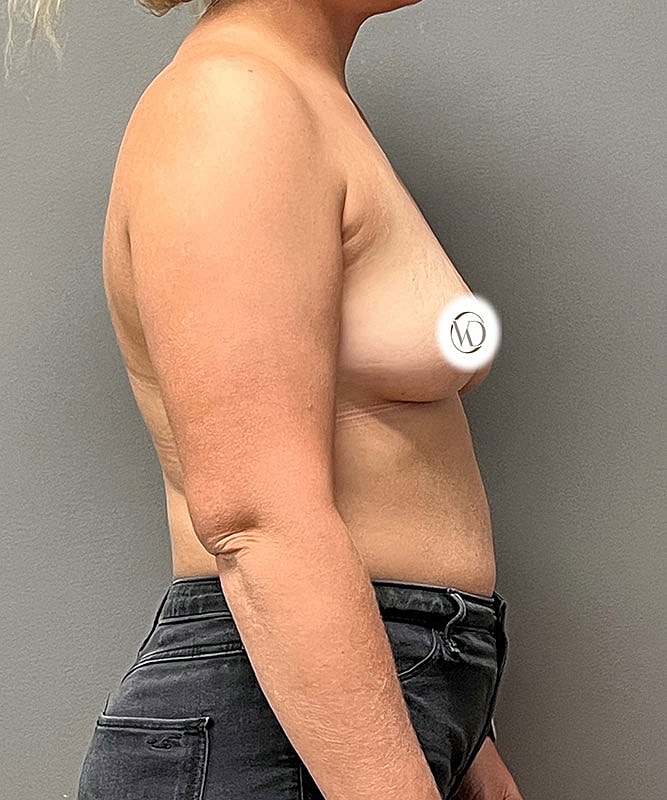Breast Augmentation Before & After