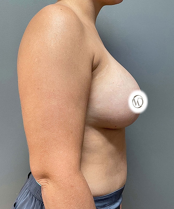 Breast Augmentation Before & After