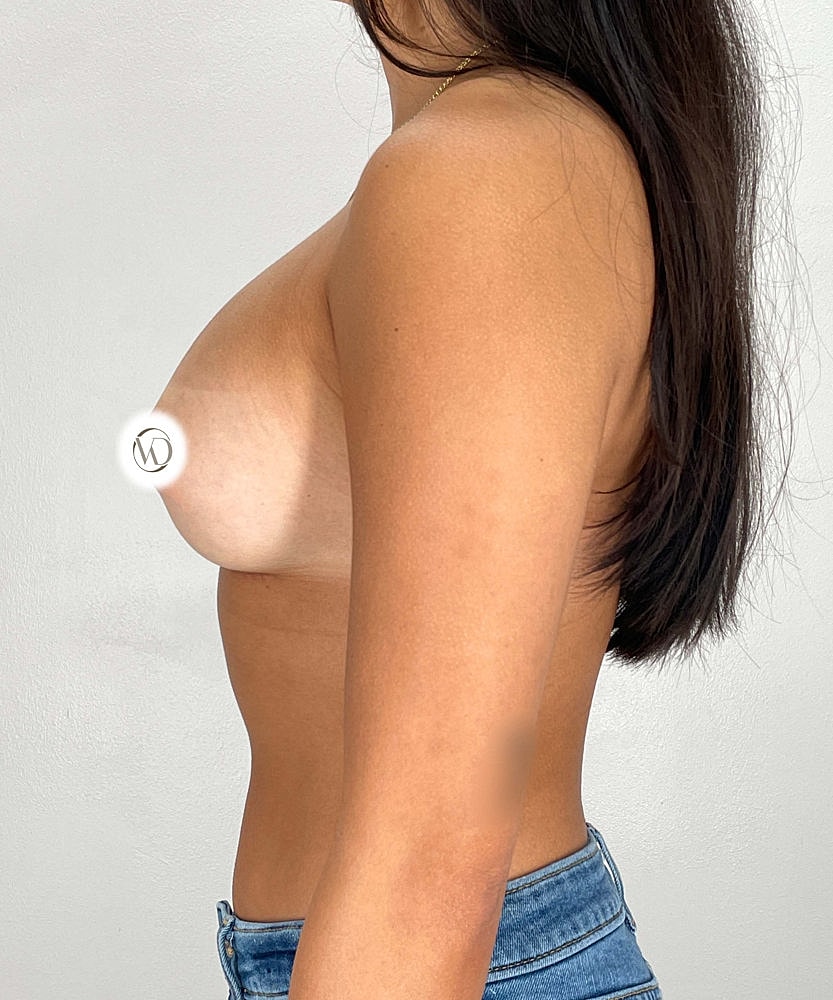 Breast Augmentation Before & After