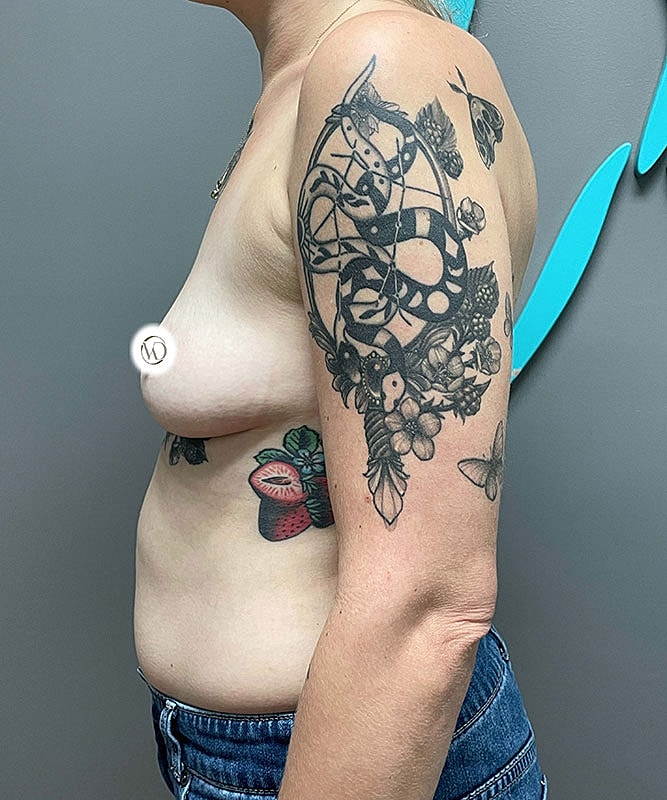 Breast Augmentation Before & After