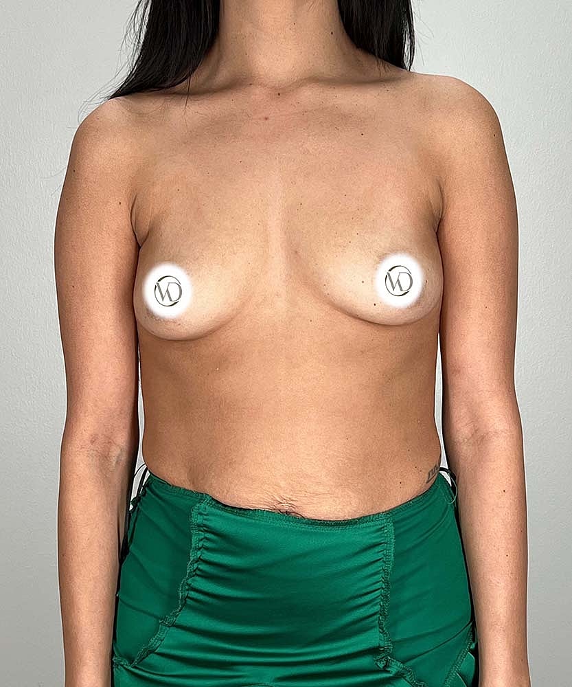 Breast Augmentation Before & After