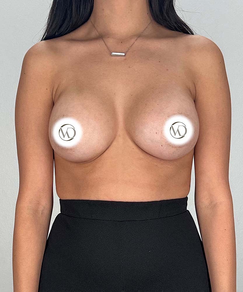 Breast Augmentation Before & After