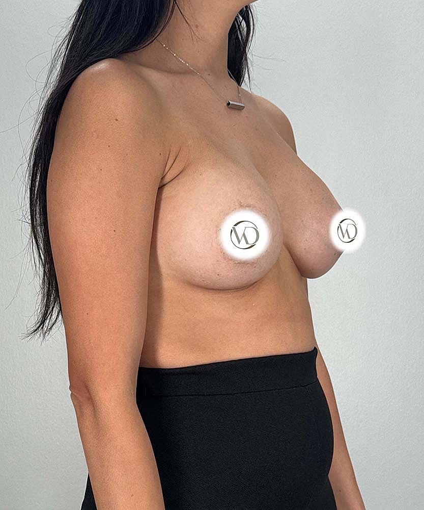 Breast Augmentation Before & After