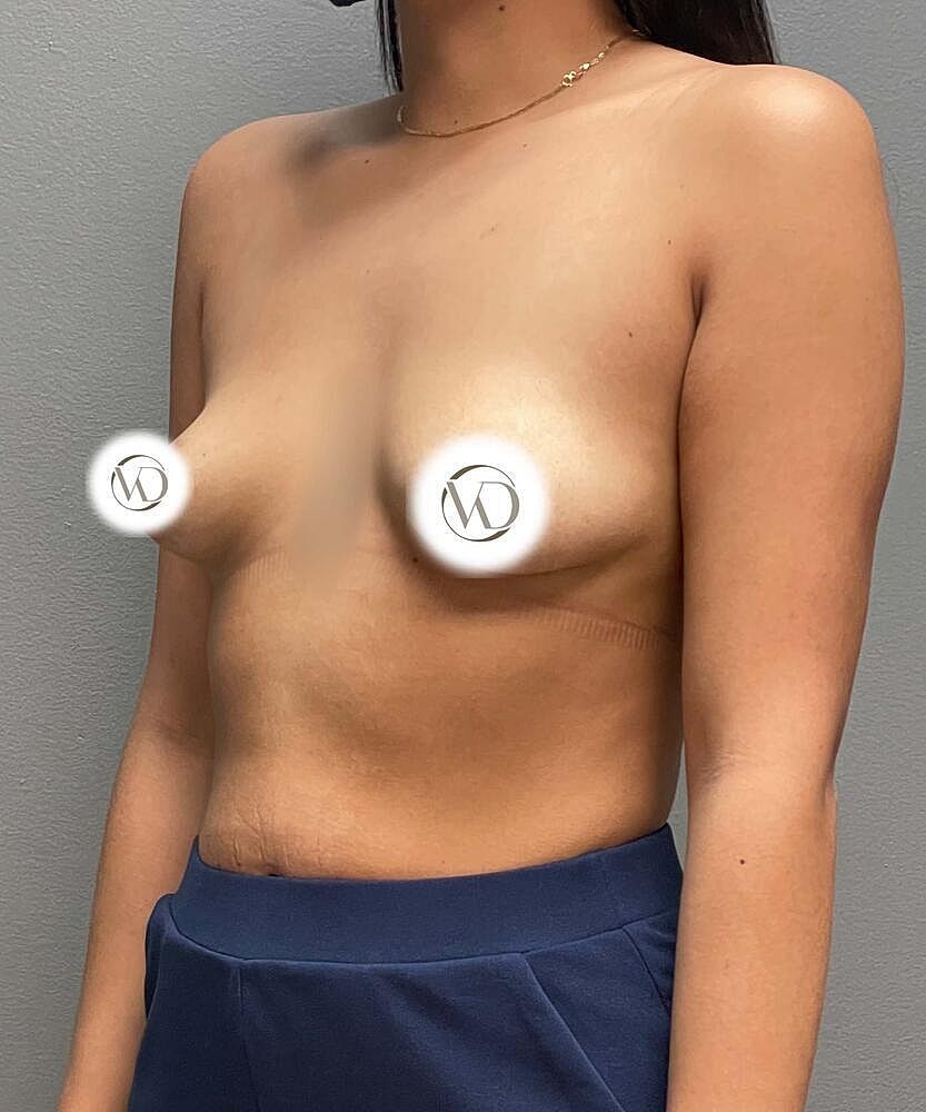 Breast Augmentation Before & After