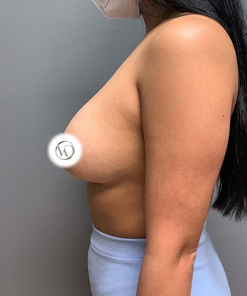 Breast Augmentation Before & After