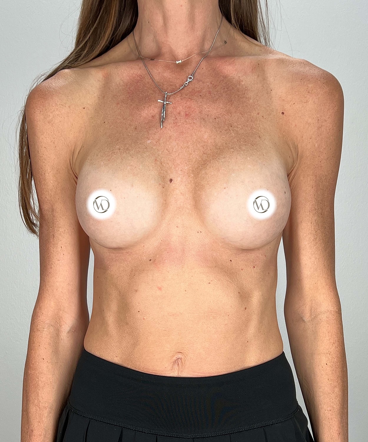Breast Augmentation Before & After