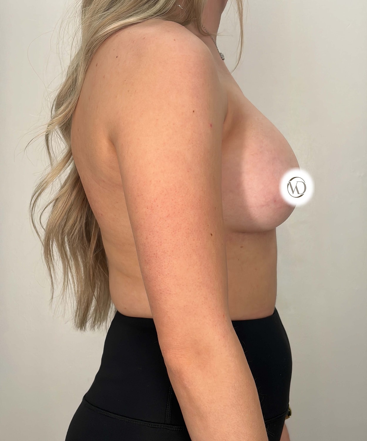 Breast Augmentation Gallery Before & After