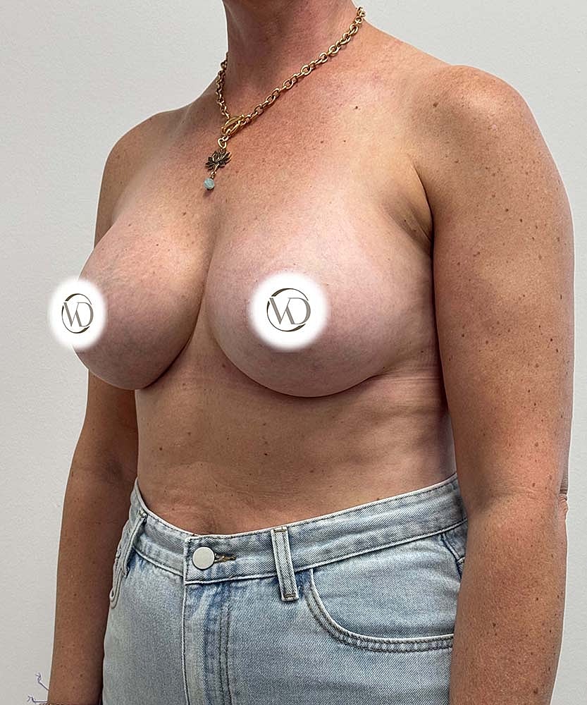 Breast Augmentation Before & After