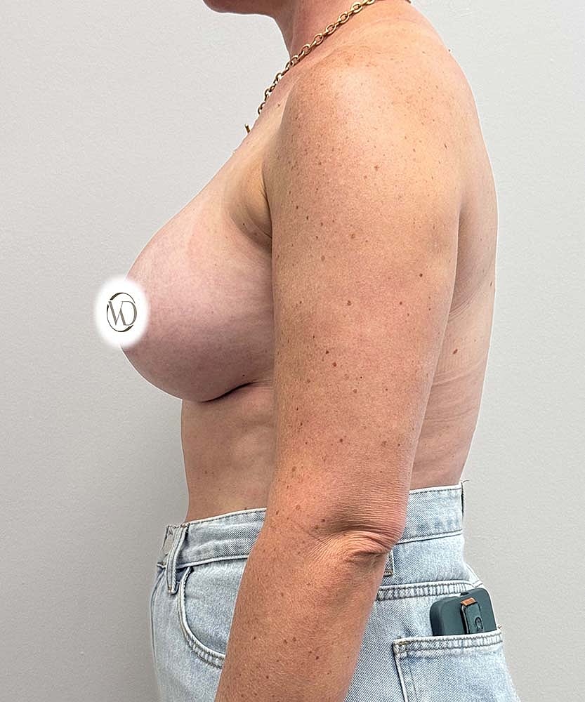 Breast Augmentation Before & After