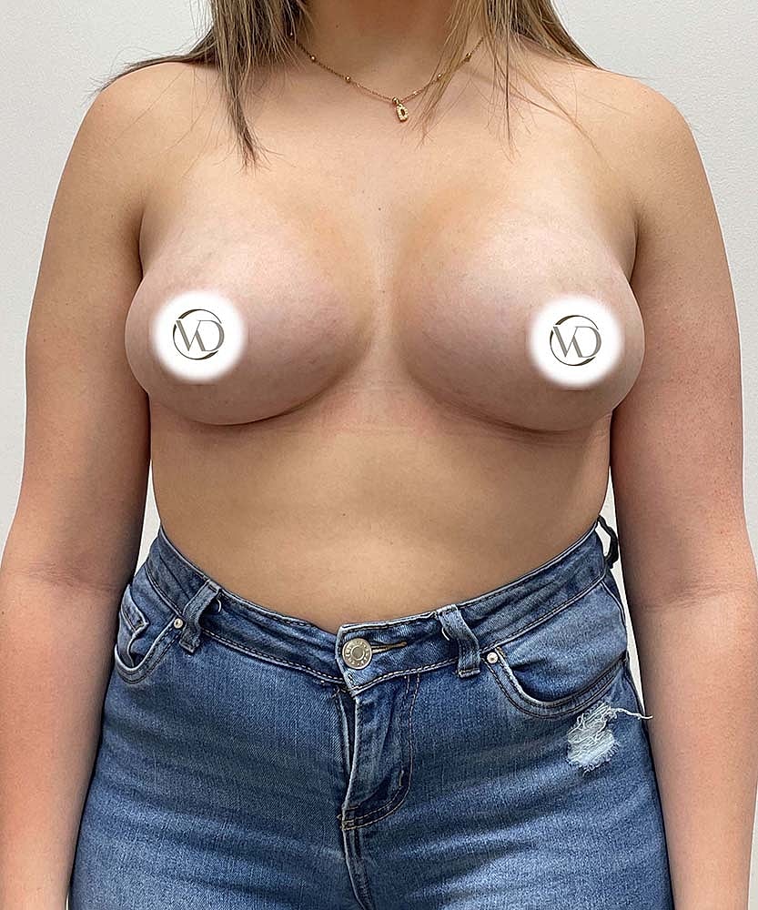 Breast Augmentation Before & After