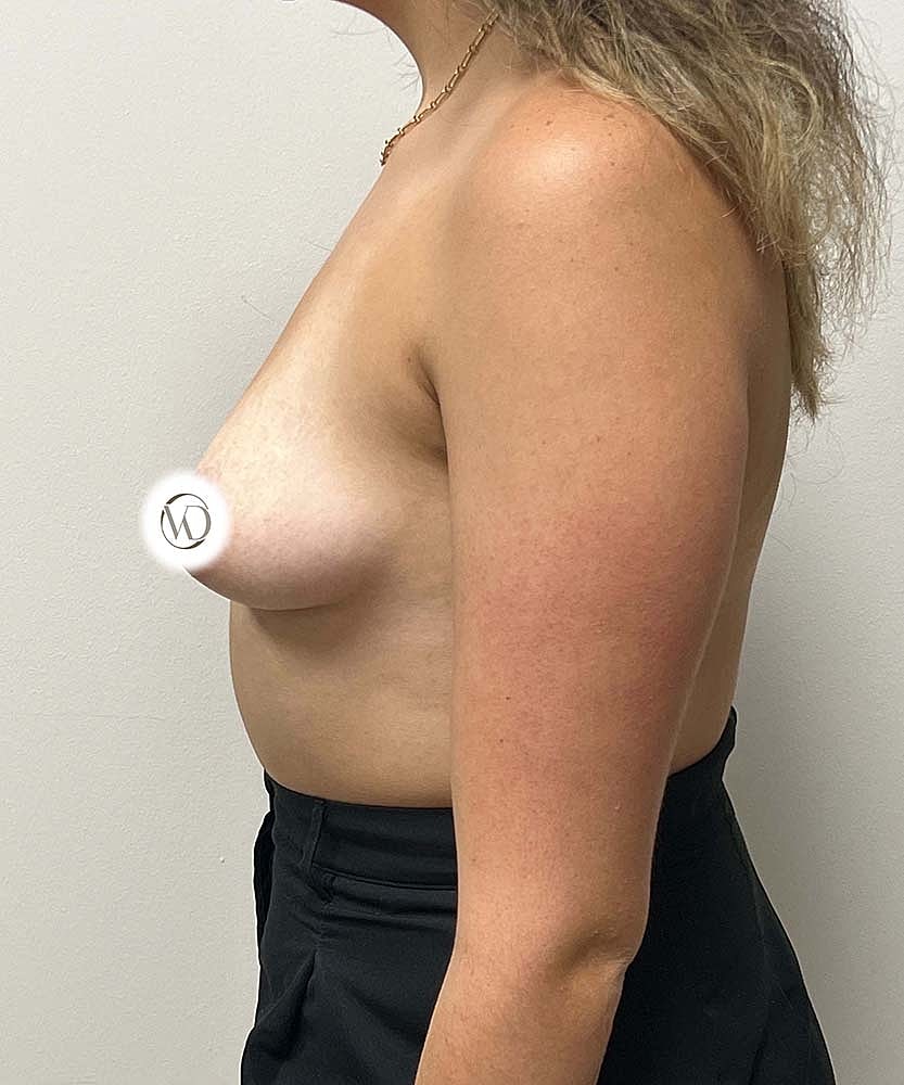 Breast Augmentation Before & After
