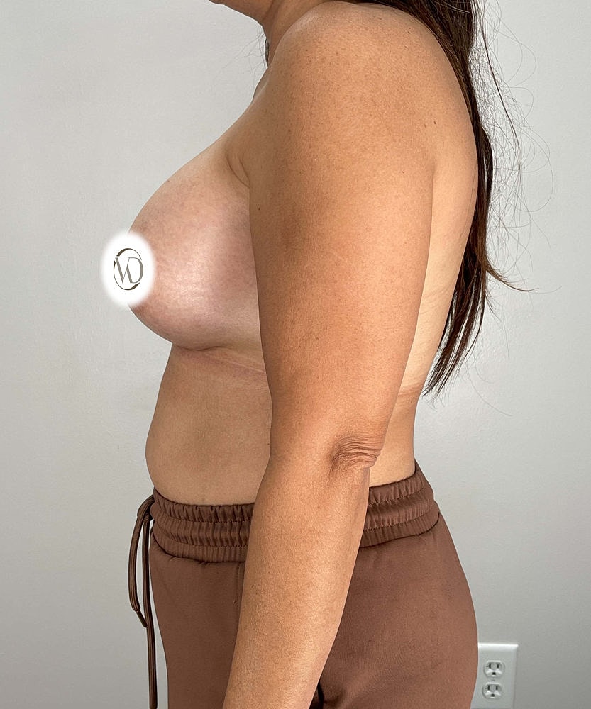 Breast Augmentation Before & After