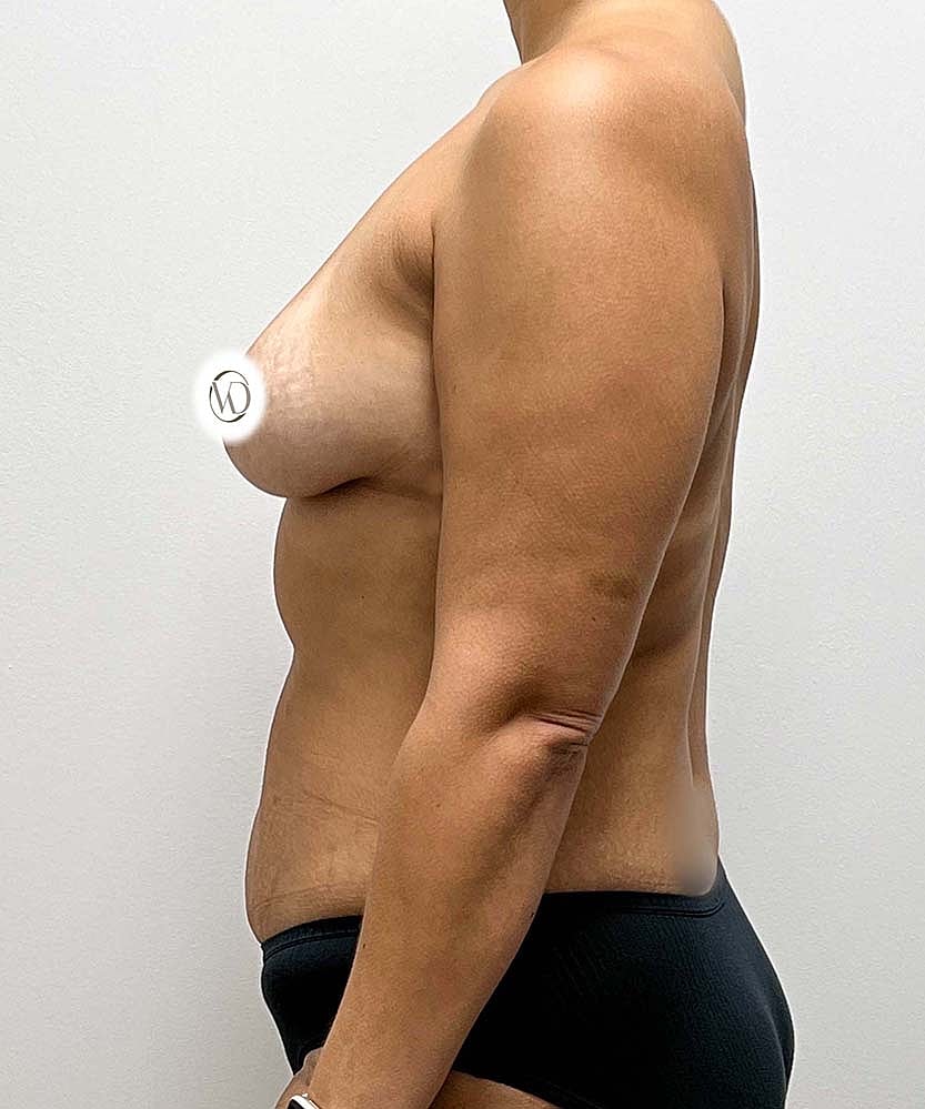 Breast Augmentation Before & After