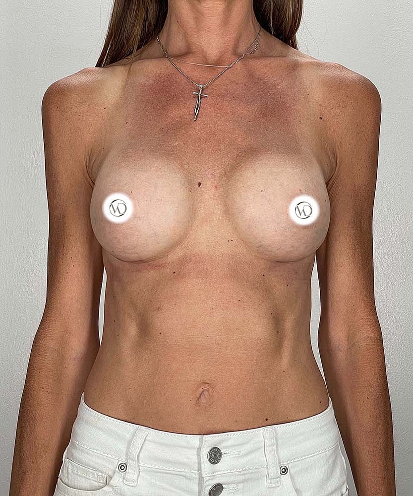 Breast Augmentation Before & After