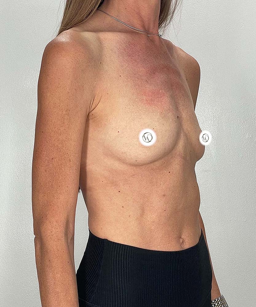 Breast Augmentation Before & After