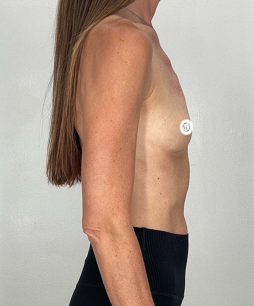 Breast Augmentation Before & After