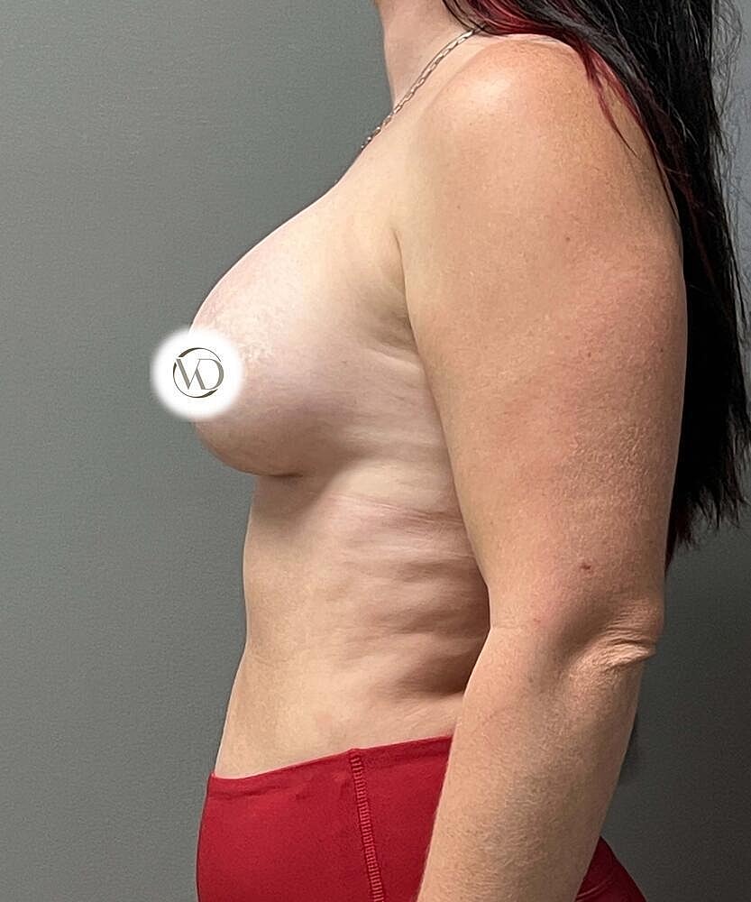 Breast Augmentation Before & After
