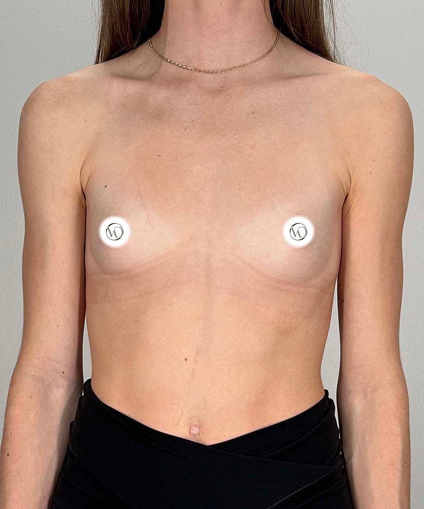 Breast Augmentation Before & After