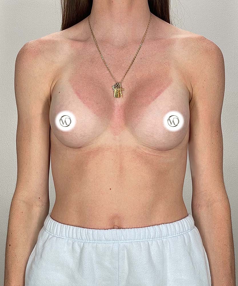 Breast Augmentation Before & After
