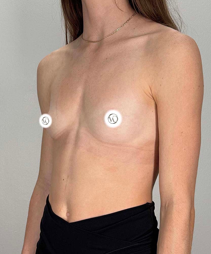Breast Augmentation Before & After