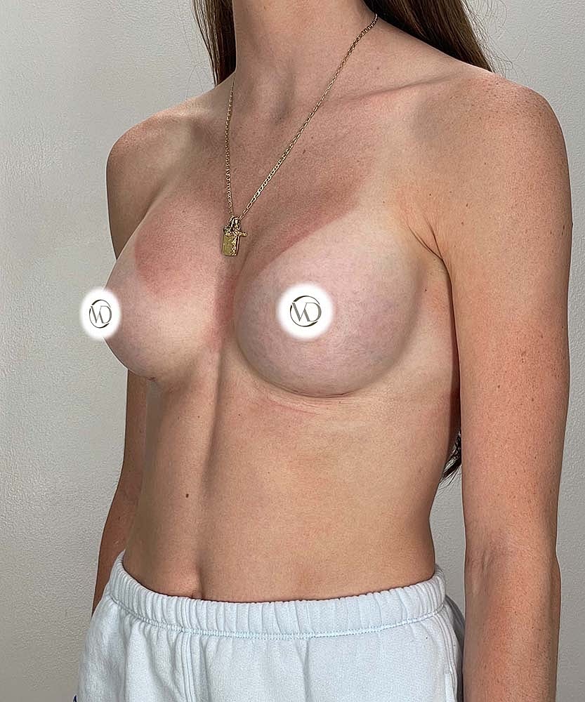 Breast Augmentation Before & After