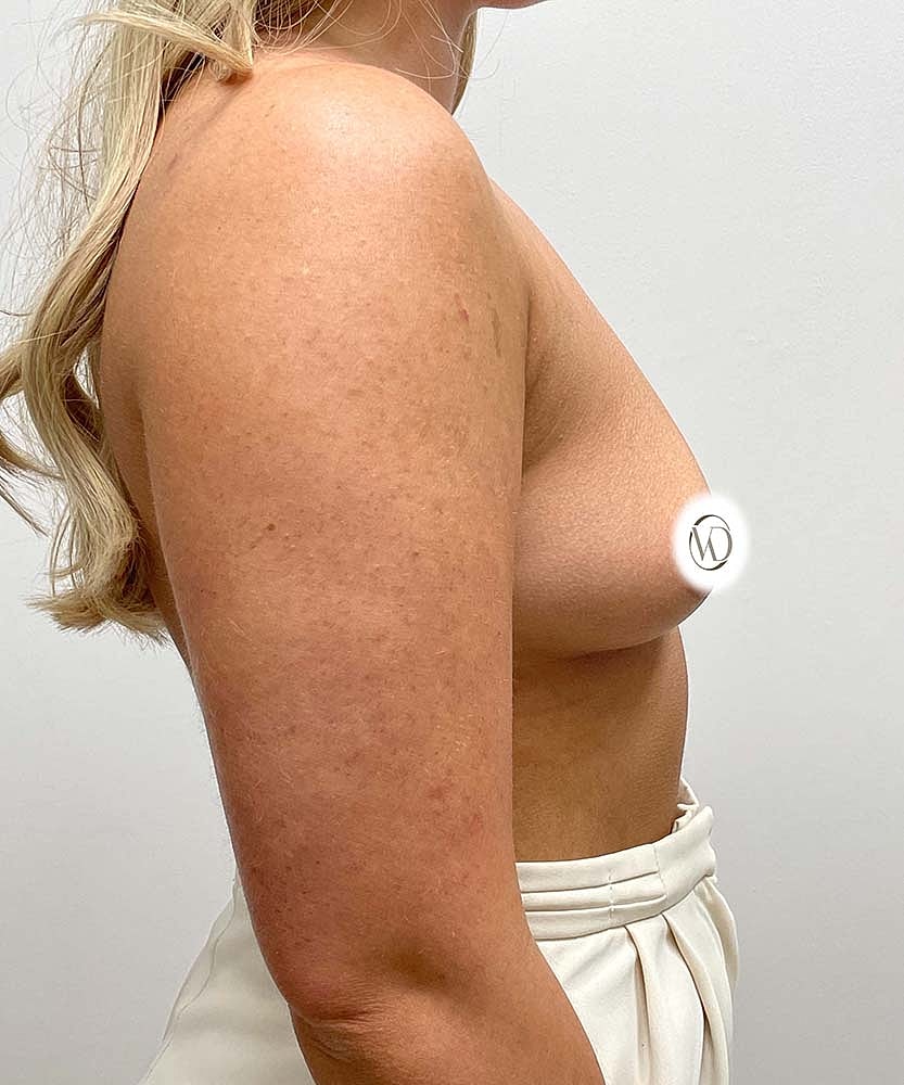 Breast Augmentation Before & After