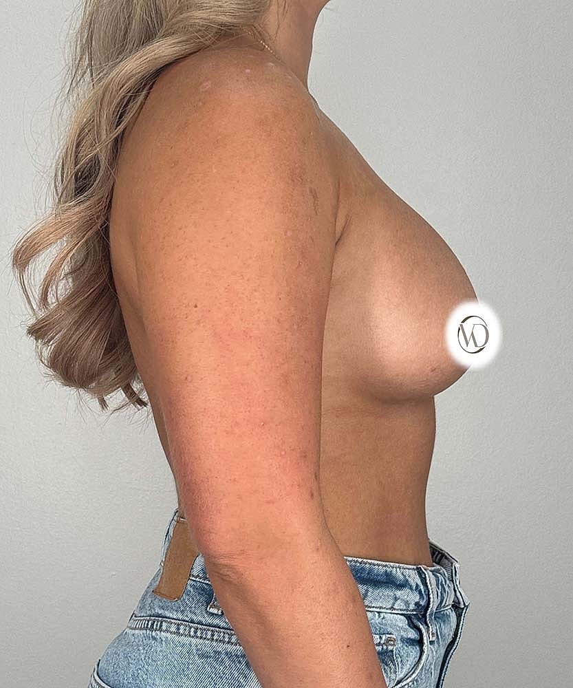 Breast Augmentation Before & After