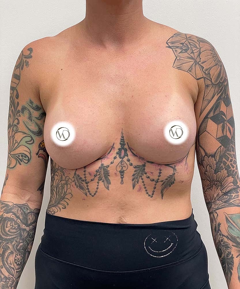 Breast Augmentation Before & After