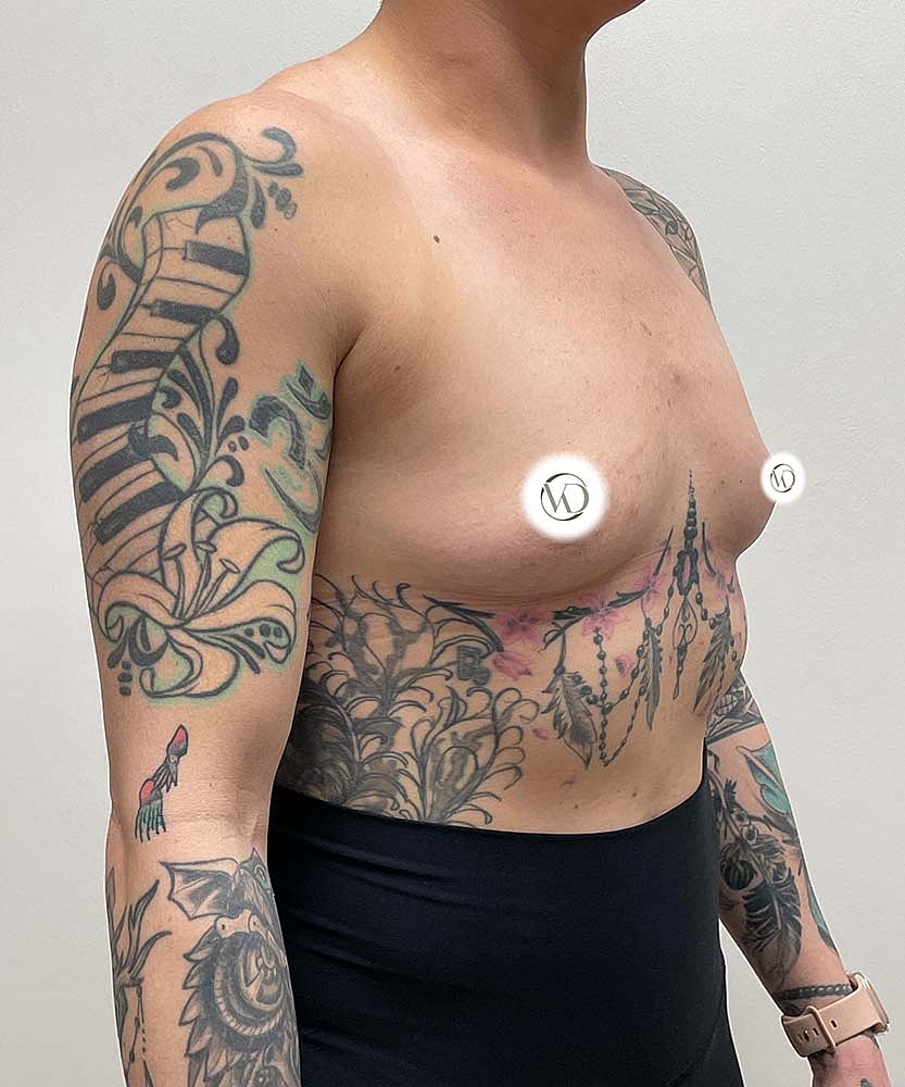 Breast Augmentation Before & After