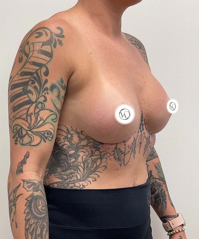Breast Augmentation Before & After