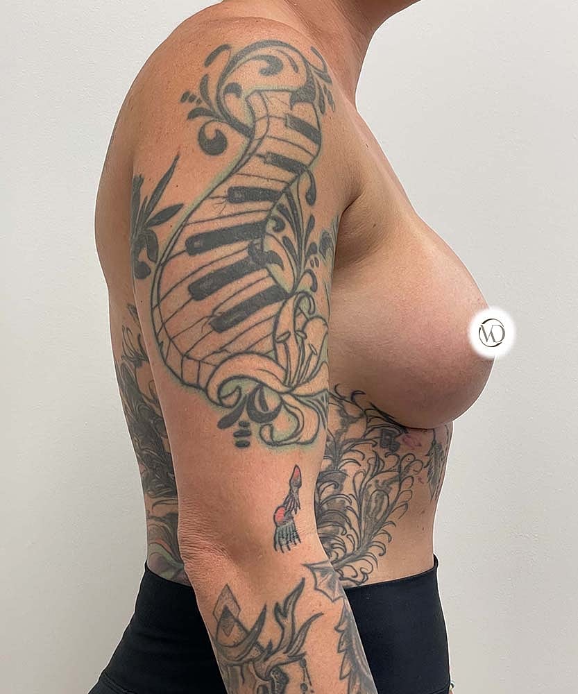 Breast Augmentation Before & After