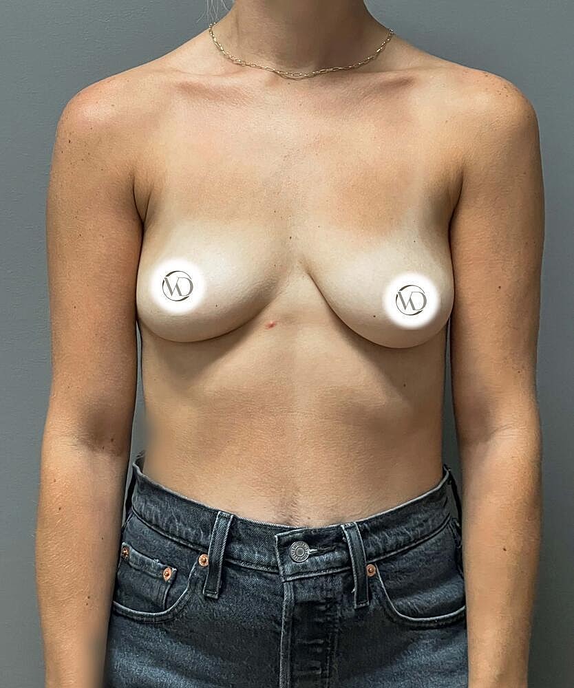 Breast Augmentation Before & After