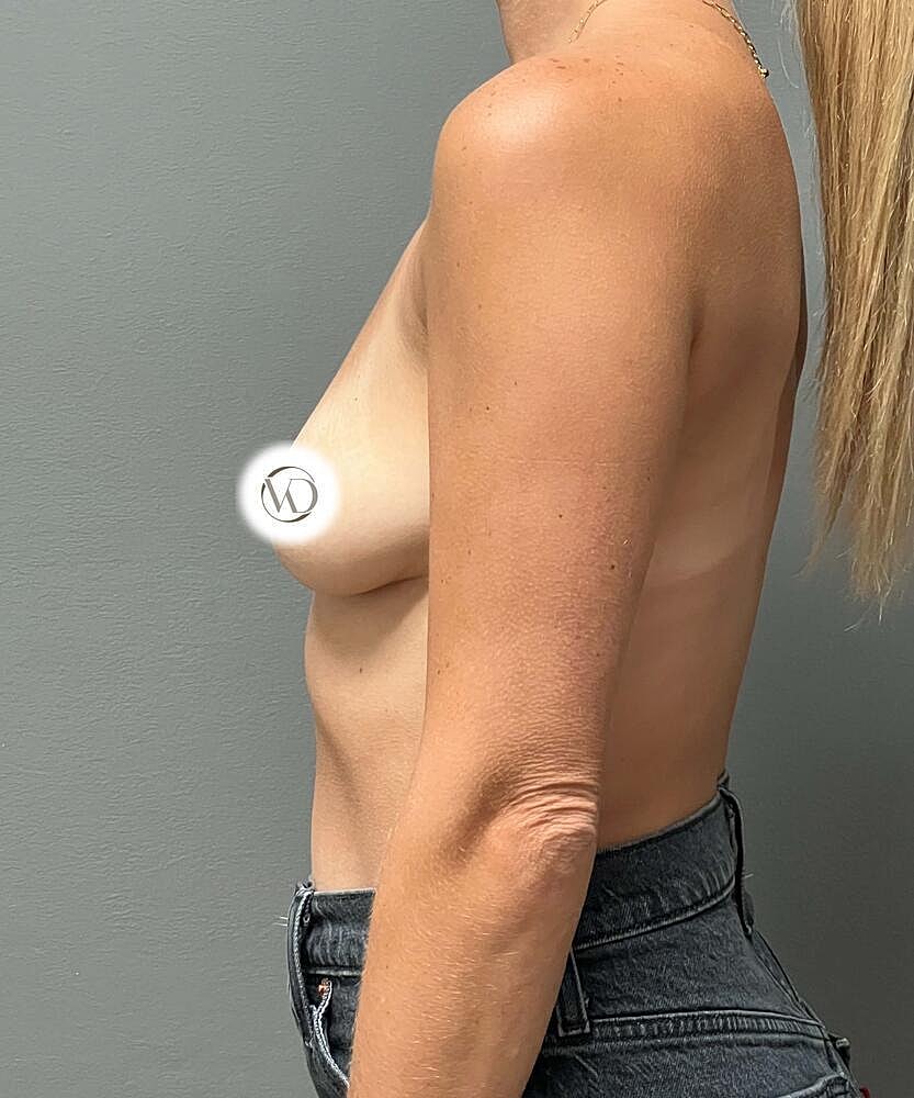 Breast Augmentation Before & After