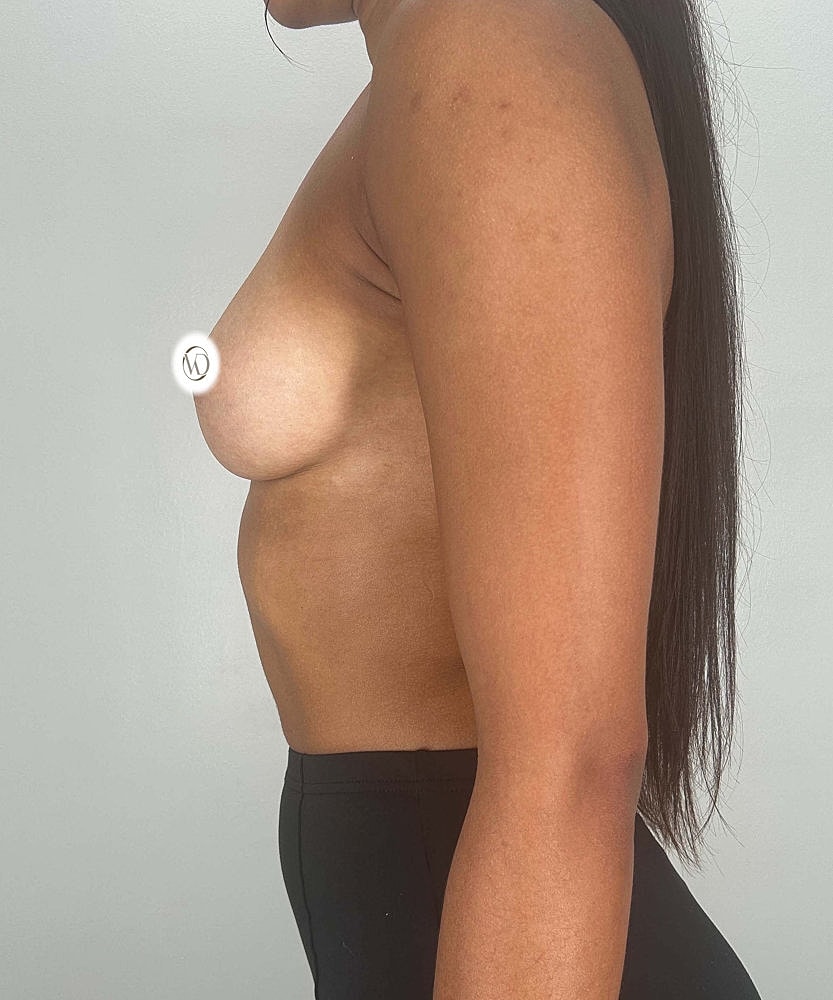 Breast Augmentation Before & After
