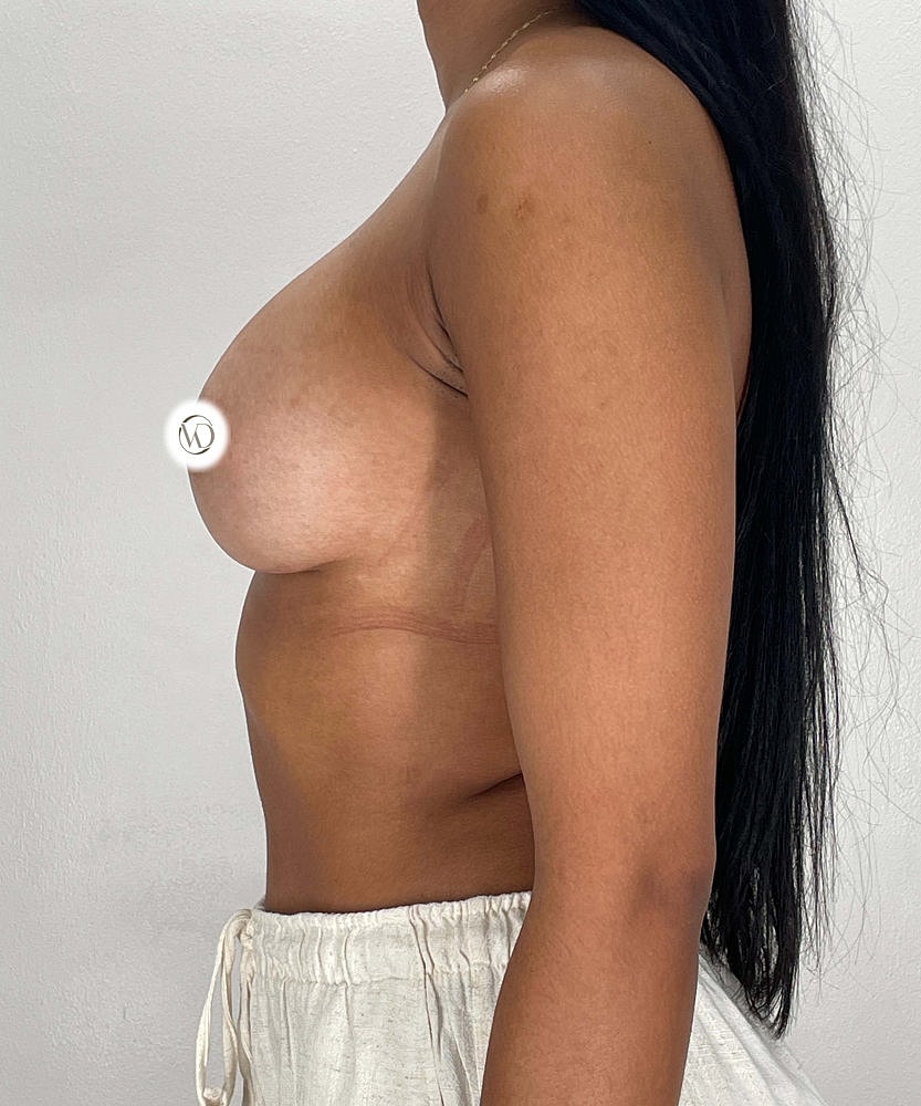 Breast Augmentation Before & After