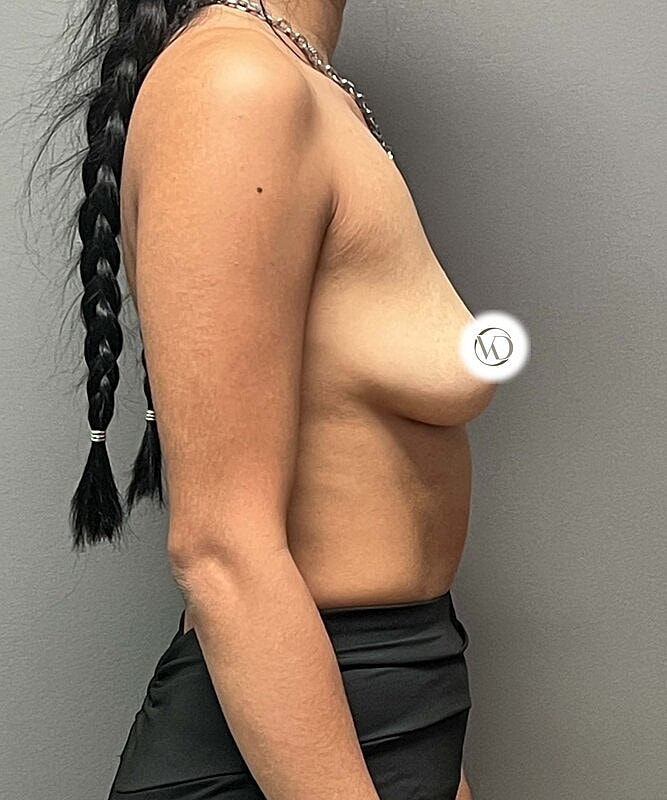 Breast Augmentation Before & After