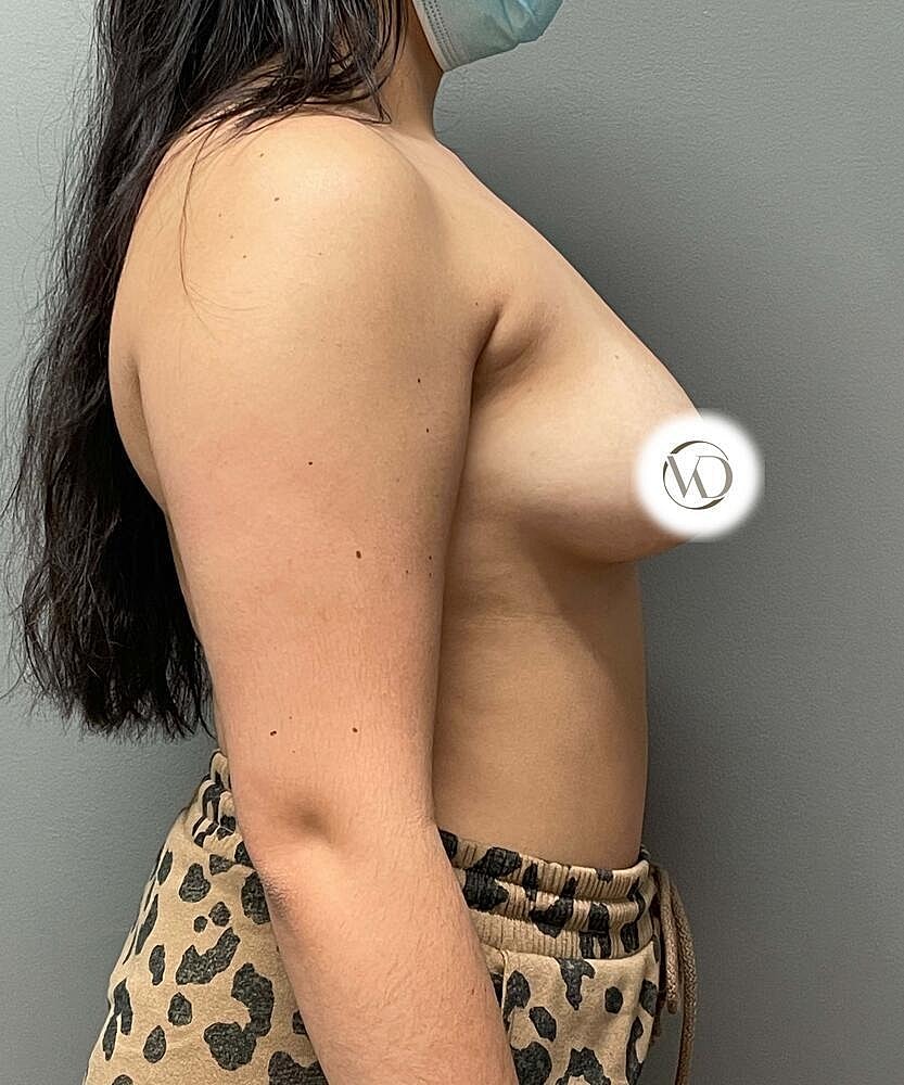 Breast Augmentation Before & After