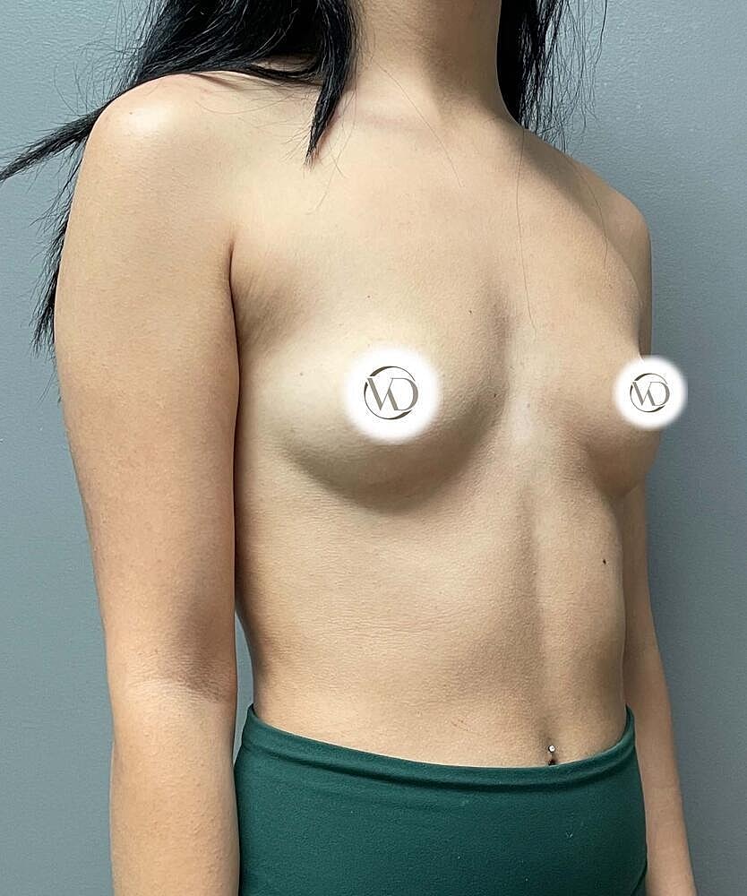 Breast Augmentation Before & After