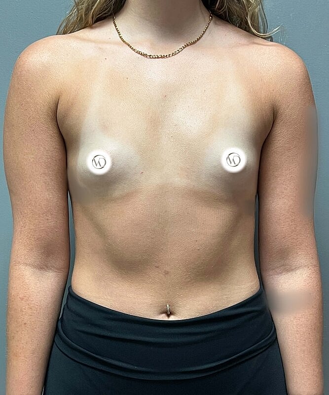 Breast Augmentation Before & After