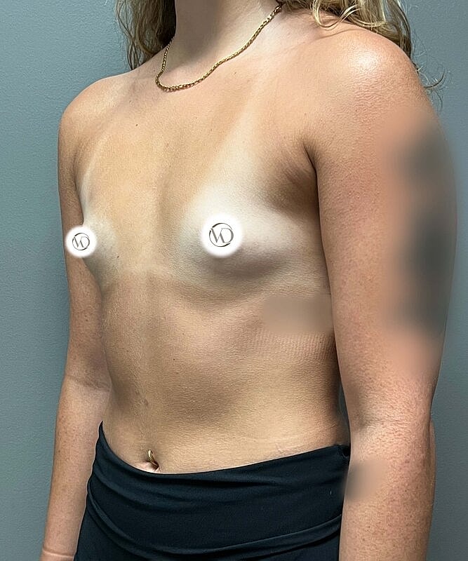 Breast Augmentation Before & After